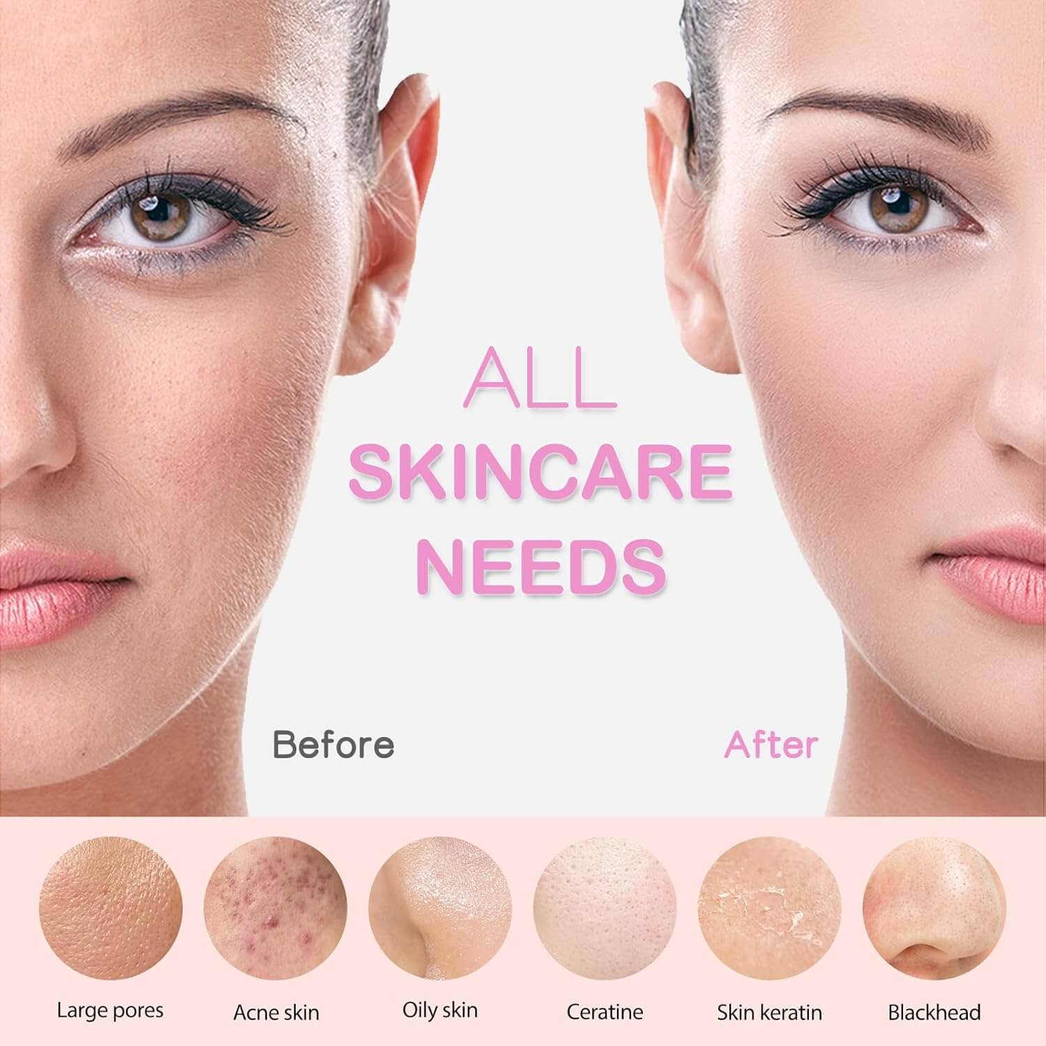 Before and after skincare transformation highlighting various skin concerns like large pores, acne, and blackheads.