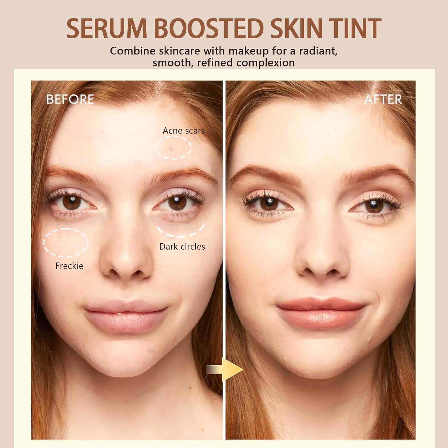 Before and after image showing the effects of Serum Boosted Skin Tint on acne scars, dark circles, and freckles.